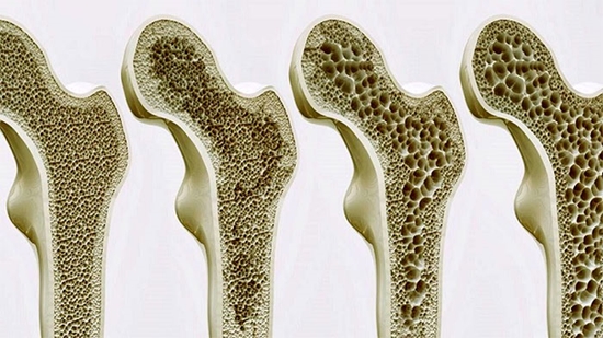 osteoporosis-01 